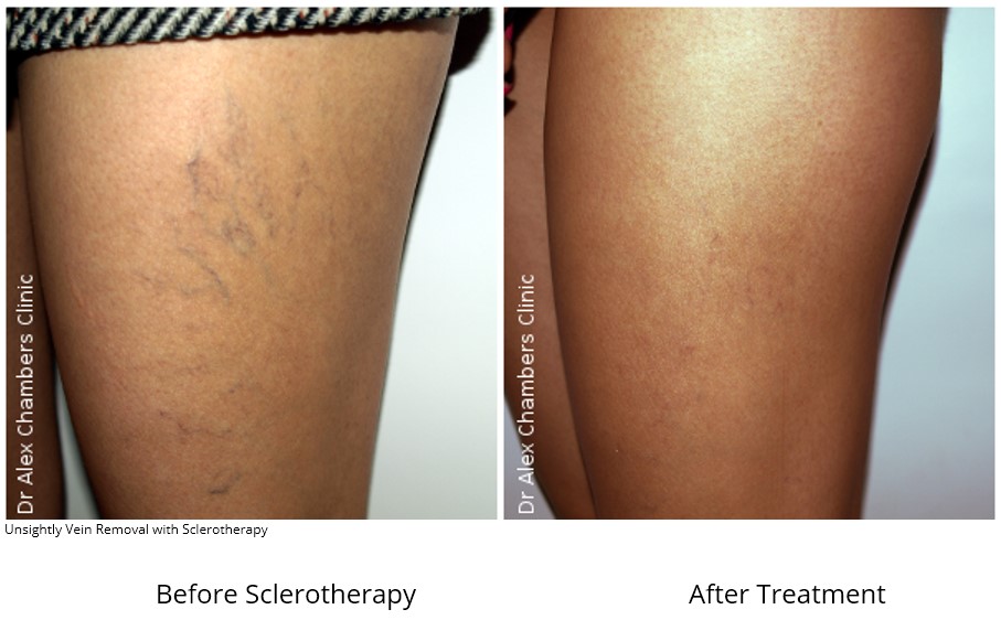 Sclerotherapy, SKIN medical aesthetics